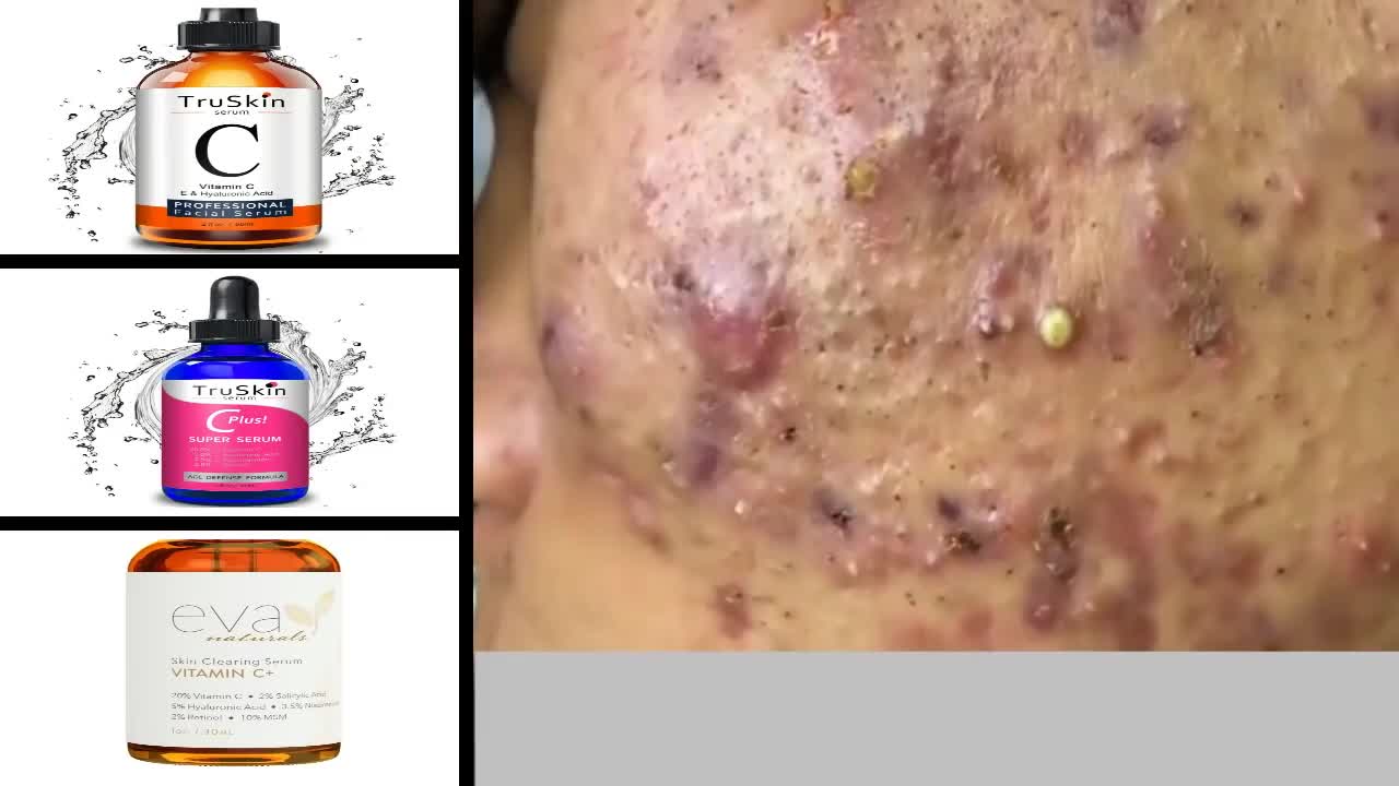 Blackheads Removal & Pimple Popping Videos 2020