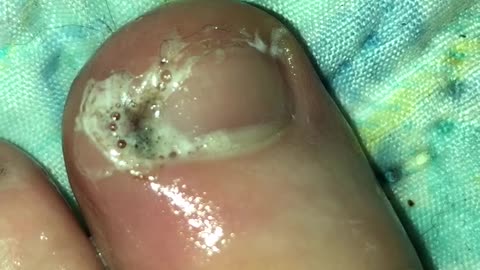 Infected toe gets peroxide