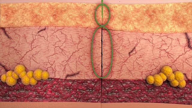 Discover the Polyglactin 910 Suture Online at Meril Life