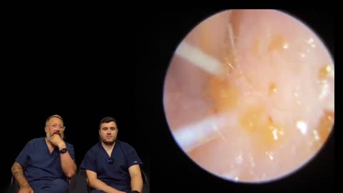 Ear Wax Extraction A MAMMOTH Ear Wax Removal - EP5