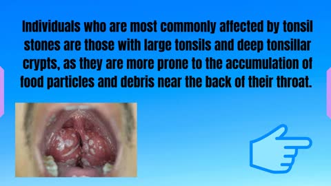 Who Can Be Affected By Tonsil Stones?