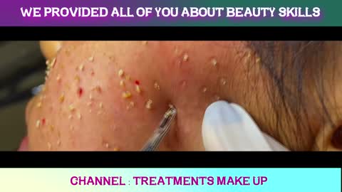 Doctor Clean Blackhead on the face woman very dirty good