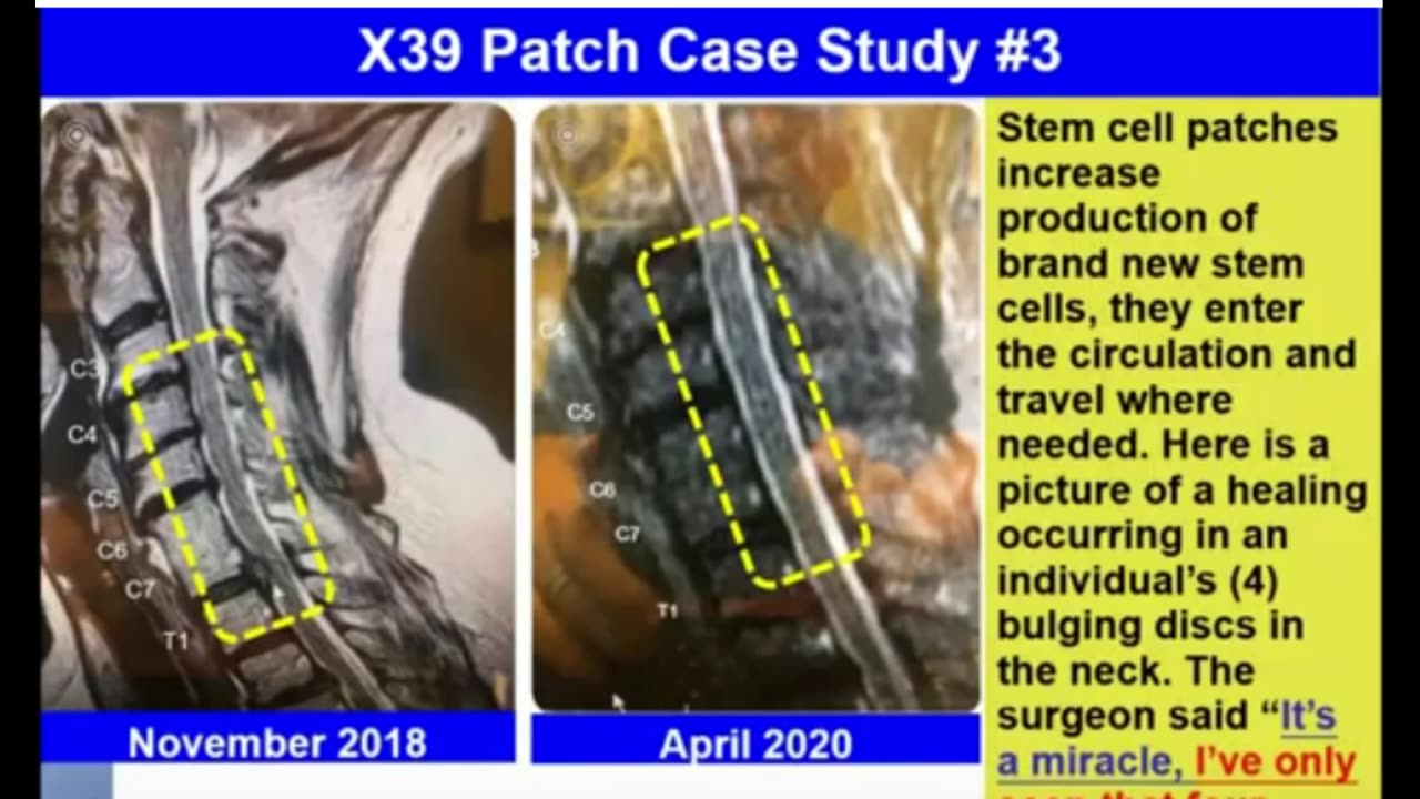 Miracle Healing of the Spine.