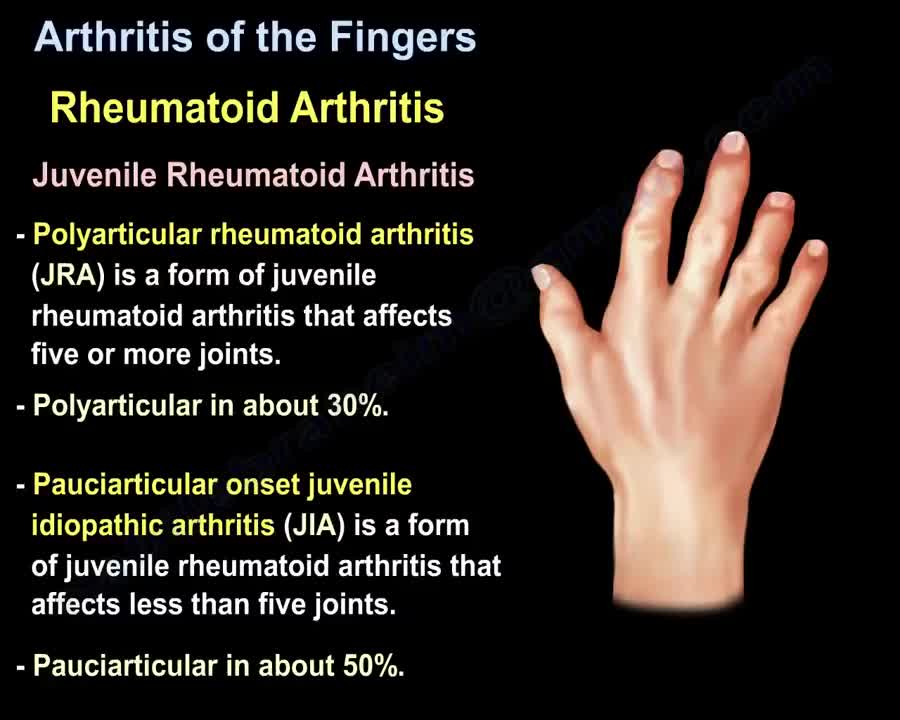 Arthritis Of The Fingers - Everything You Need To Know - Dr. Nabil Ebraheim (Cure Arthritis Naturally)