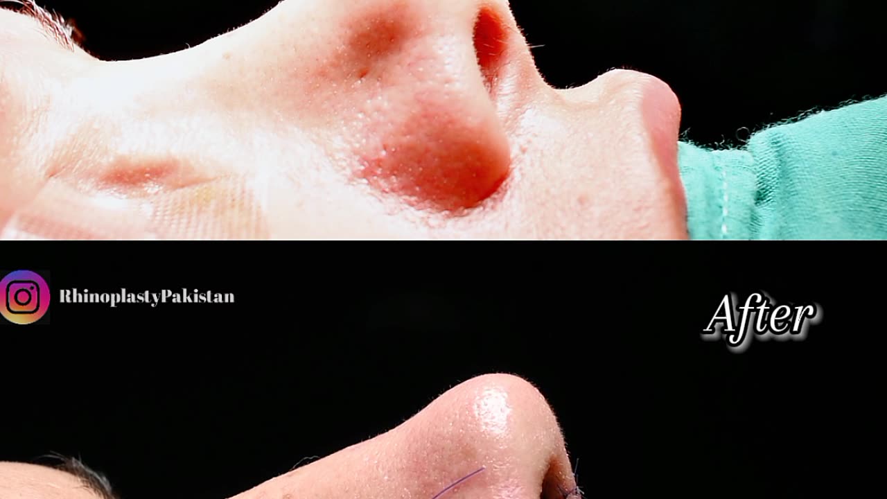 Rhinoplasty Surgery | Nose