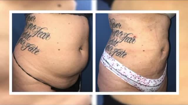 Dr. Thomas BARNES Abdomen Liposuction Results! Must see!