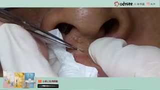 Extracting pimple