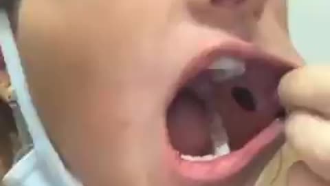 Parecen lunares pero no lo son... efectos de coagulación por el frasquito