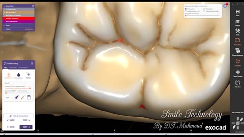 #design #naildesign #dental #dentaldesign #exocadexpert