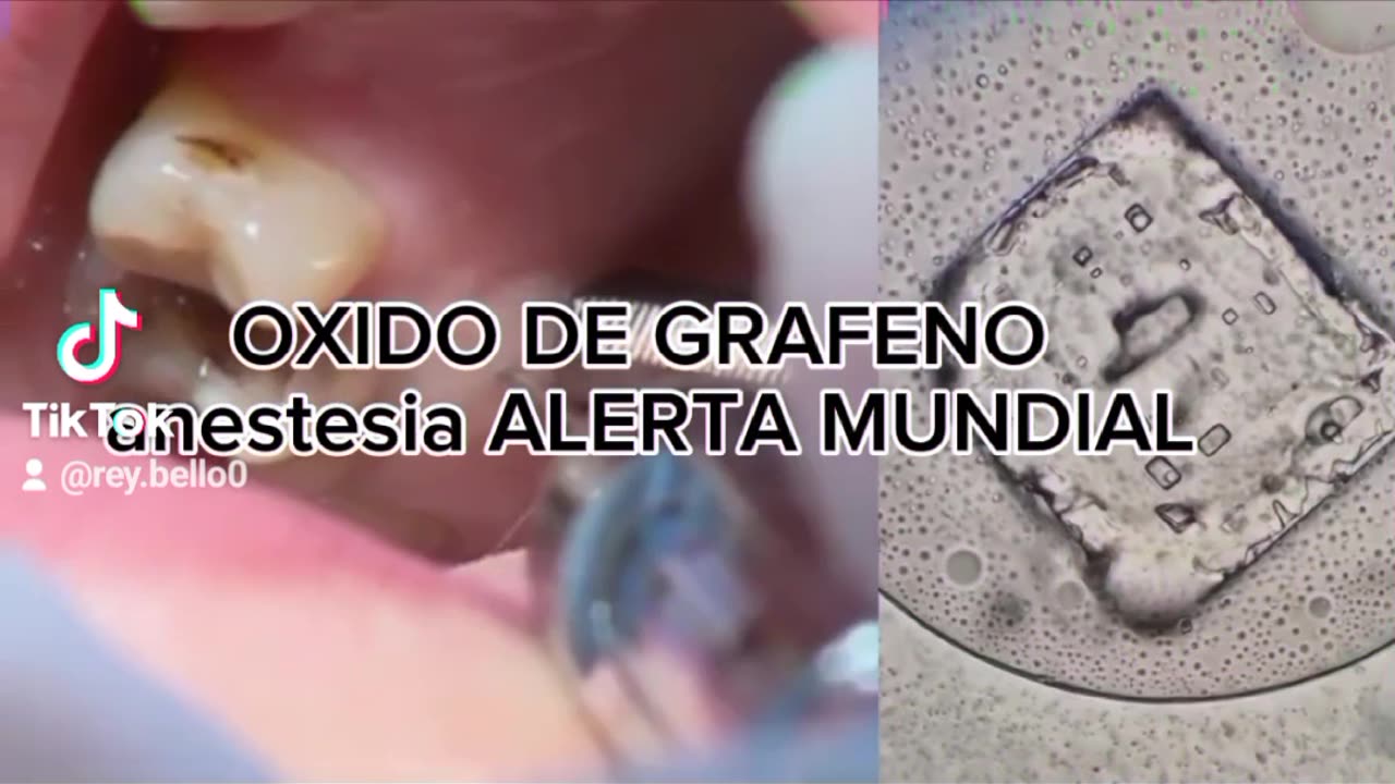 El famoso pitido al oído y sus consecuencias con los INYECTADOS con grafenito dentales