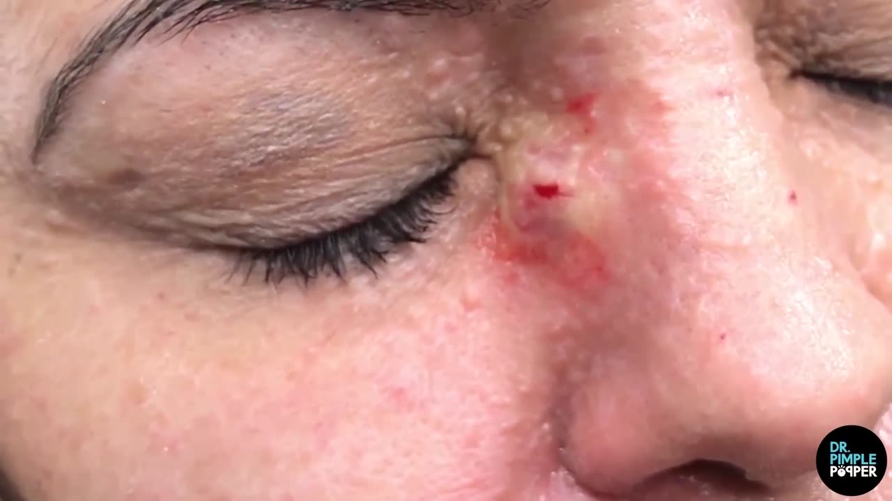 An Angry Cyst on the Nose