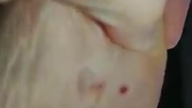 Morgellons dans les Masques maintenant le corps