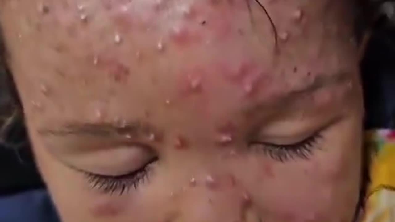 Noura Nidal Al-Shawaf, a girl from Gaza, suffers from a virus spreading across her body