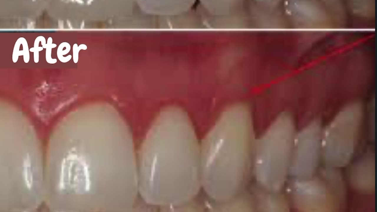 How to stop receding gums | tissue grafting | #periodontics#dentalprocedures