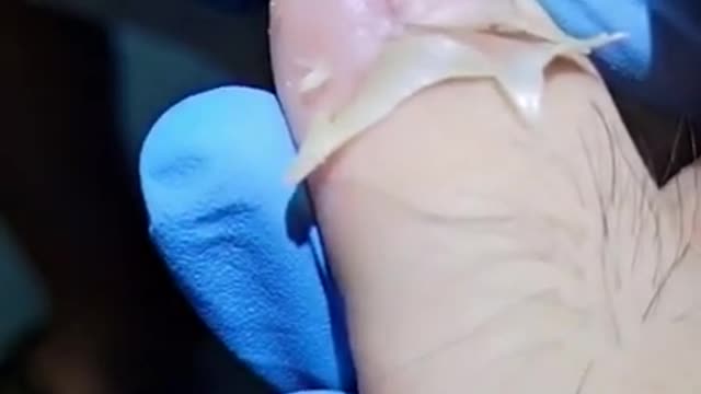 Removal of ingrown toe nail [ASMR]