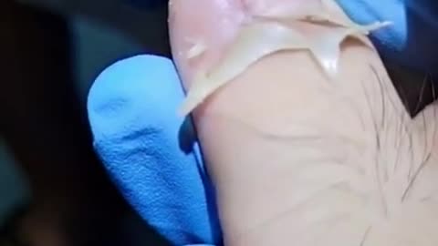 Removal of ingrown toe nail [ASMR]