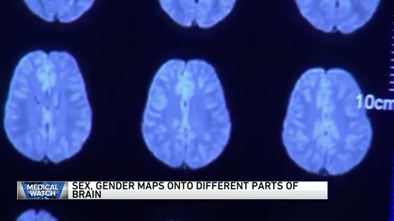 Sex, gender maps onto different parts of the brain, research shows | WGN News