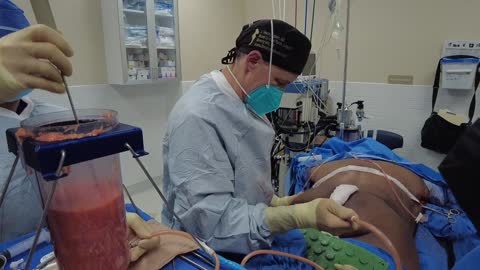 Horizontal Torsoplasty plus a Brazilian Buttock Lift aka BBL