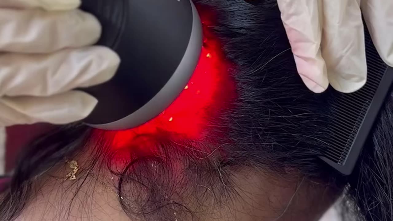 Unlocking Hair Regrowth: The Genesis of Defeating Baldness
