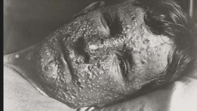 What About Smallpox?
