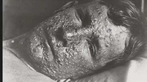 What About Smallpox?