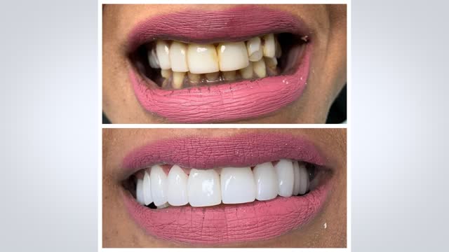 Kendall Teeth Whitening At Miami Dental Group