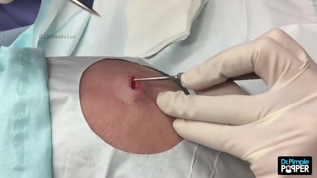 One of my FAVORITE Pilar Cysts extracted - via Suspension Suture