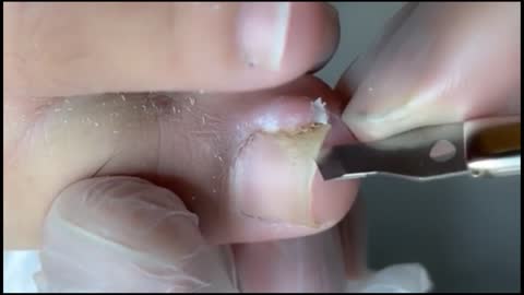 PAINLESS Infected Ingrown Toenail Removal!!!