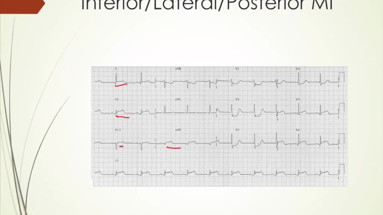 NSTEMI vs STEMI