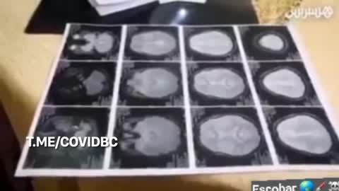 A MOROCCAN WOMAN IS LEFT WITH PERMANENT TREMORS AFTER THE COVID-19 VACCINE 💉