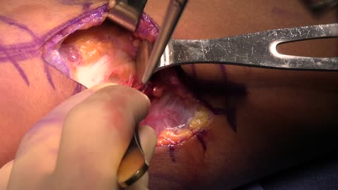 Open Lysis of Adhesions and Capsulotomy of the Elbow