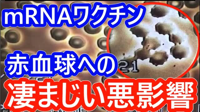 Youtube Newyork Now！のmRNAワクチン接種後の赤血球への影響