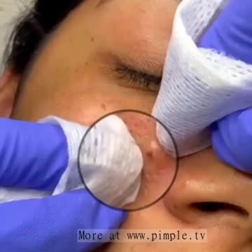 Pimple Cyst Soft Pops!!!