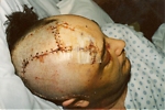 Traumatic Brain Injury - Shane's 28 year Journey