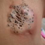 Dr.Schranz Blackheads