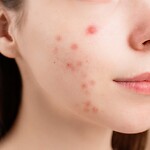 Acne Free