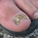 Toenail fungus