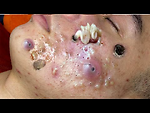 PimplePopper Spa & blackheads removal